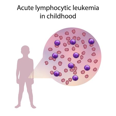Acute lymphocytic leukemia in childhood. Immature lymphocytes. Medical anatomy illustration.の写真素材