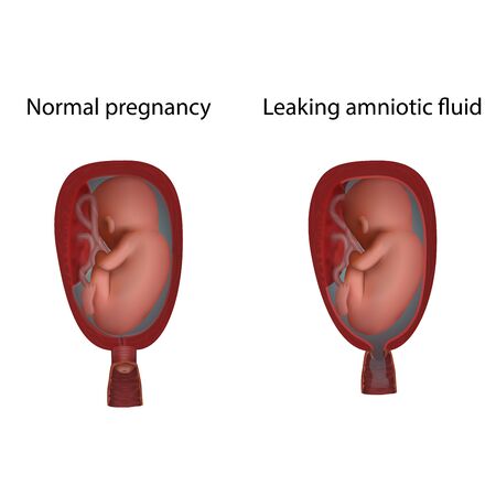 Photo of Normal and leaking amniotic - ID:1-142224420 - Royalty Free
