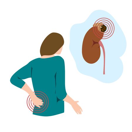 Adrenal gland tumor. Disease. Backache, woman with hand on her back, pain. Medical flat anatomy illustration.のイラスト素材