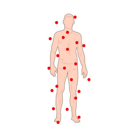 Flu human infected. Virus, bacteria, man, infection.のイラスト素材