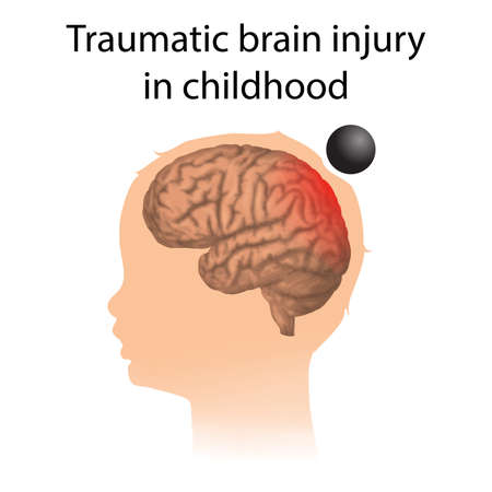 TBI. Traumatic brain injury in childhood. Kid, child head damage.のイラスト素材