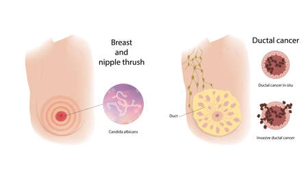 Woman breast and nipple thrush, ductal cancer. Comparison. Medical vector illustration.のイラスト素材