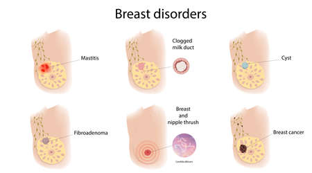 Woman breast disorders. Mastitis, cyst, thrush, cancer, Fibroadenoma, Clogged milk duct. Medical vector illustration.のイラスト素材