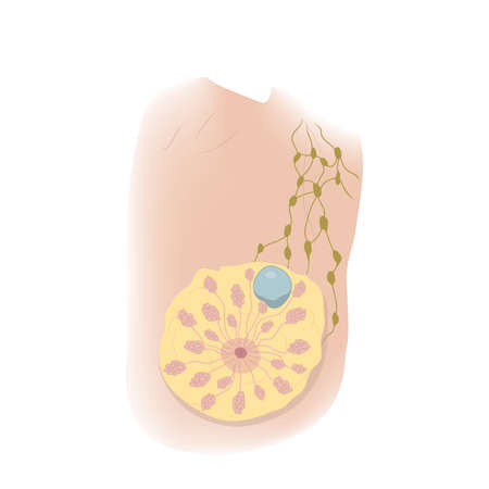 Woman breast disorders. Cyst. Medical vector illustration.のイラスト素材