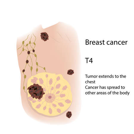 Woman breast. Cancer T4 Tumor extends to the chest spread to other areas of the body view with description. Medical vector illustration.のイラスト素材