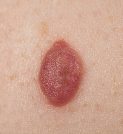 Inborn mole close up. Macro shot of benign skin lesion. Proliferation of pigment derma cells,...