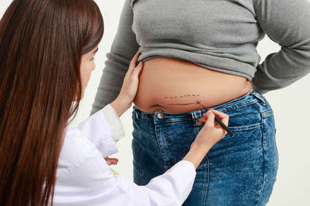 Asian female doctors use a pen to draw a line on the belly of an obese woman. Concept of plastic surgery. Hospital medical servicesの写真素材