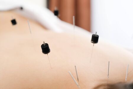 Woman stabbed in the back with needle in bright acupuncture clinicの写真素材