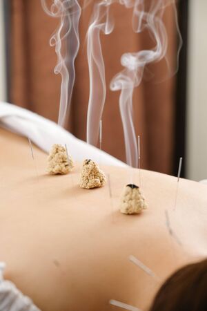 Needles and porridge stuck in a woman's back in a bright acupuncture clinicの写真素材