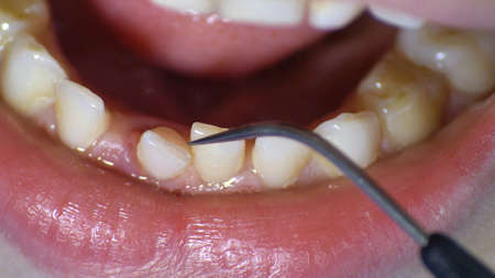 Dentist Inspecting Loose Tooth with Dental Probeの写真素材