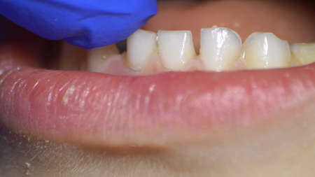 Dentist Inspecting Loose Tooth in Blue Gloves