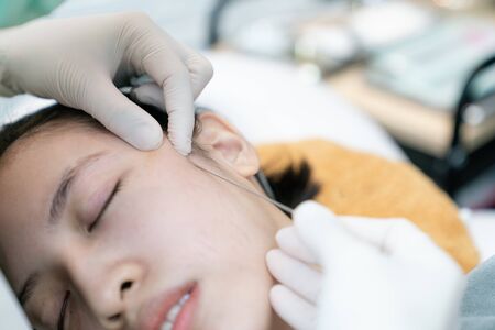 Close-up of fine Thread Lifting, PDO thread. Aesthetic beauty anti aging, face lifting surgery.の写真素材