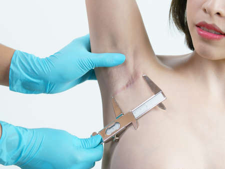 Doctor hand measurement keloids or scar on the armpit after breast surgery with caliper, breast...