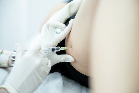 Cellulite Treatment, correction body fat with lipolytics. Doctor injections on thigh.の写真素材