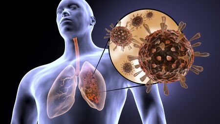 Coronavirus attacks human lungs and causes pneumonia.の写真素材