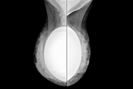 Comparative mammogram in middle-lateral projection of a patient for the control of breast implantsの写真素材