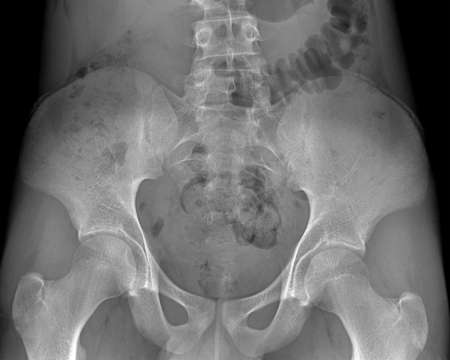Radiography of the pelvis of a patient with hip pain