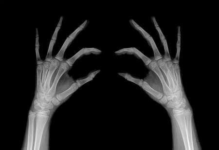 Radiography of the fingers of the hands in comparisonの写真素材