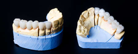 Dental jaw model on a black background. Dentistry concept.