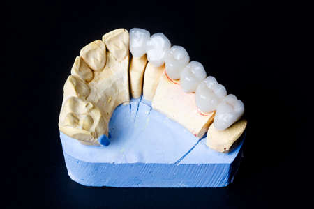 Dental prosthetic dentistry. Medically accurate dental 3D illustration of human teeth and dentures.の写真素材