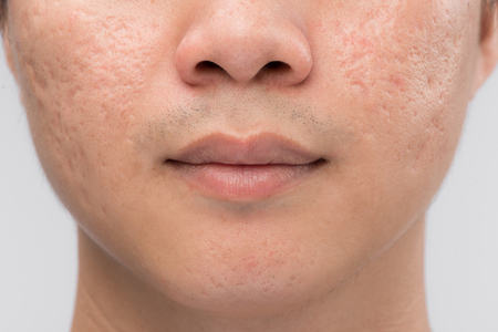 Man with oily skin and acne scars isolated on white backgroundの写真素材