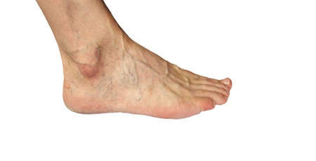 spider veins on and protruding veins male leg on white backgroundの写真素材