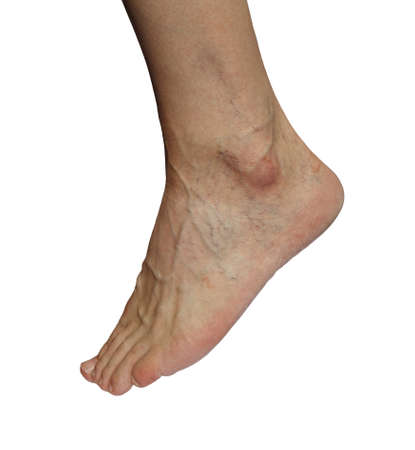 Convex veins and spider veins on a male legの写真素材
