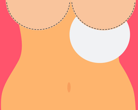Breast augmentation. Insertion of implants in the body.のイラスト素材