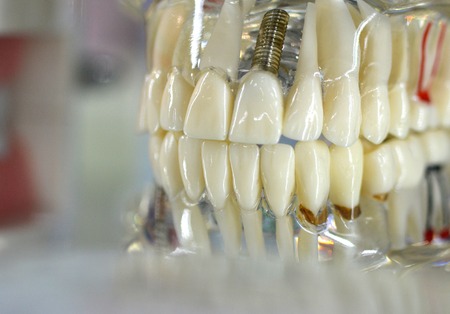 Transparent Model of Human Teeth with implants close-upの写真素材