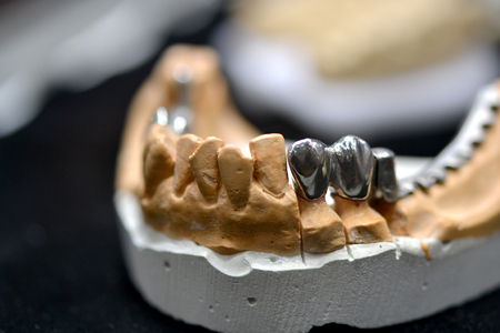example of a bridge on an artificial human jaw close-upの写真素材