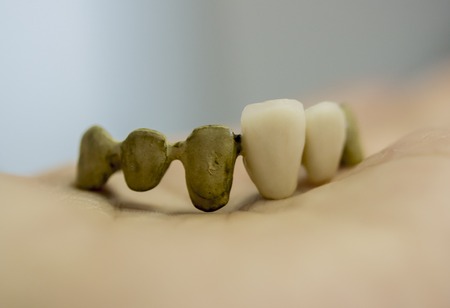medical dental bridge and crowns close-up copy sspaceの写真素材