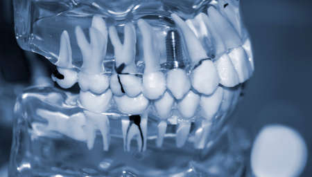 Transparent Model of Human Teeth with implants close-up.