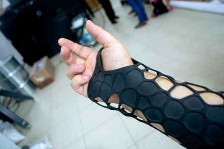Black orthopedic plastic prosthesis printed on powder 3D printer on hand. Orthopedic gypsum is on arm close-up.の写真素材