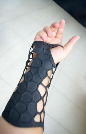 Black orthopedic plastic prosthesis printed on powder 3D printer on hand. Orthopedic gypsum is on arm close-up.の写真素材