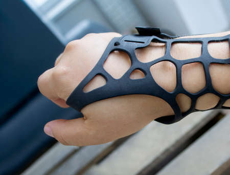 Black orthopedic plastic prosthesis printed on powder 3D printer on hand. Orthopedic gypsum is on arm close-up.の写真素材