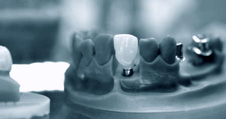 Collapsible jaw model wih teeth and holes for implant crownの写真素材