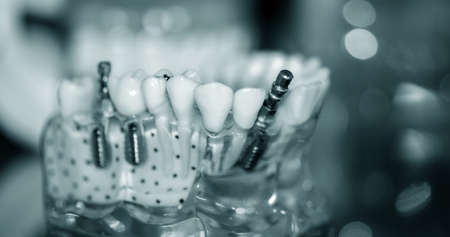 Transparent Model of Human Teeth with implants close-upの写真素材