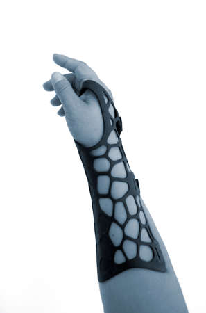 Orthopedic plastic prosthesis printed on powder 3D printer on hand. Isolated on white background. Gypsum close-up. Multi Jet Fusion MJF 3D printing technology. Modern progressive additive technologyの写真素材