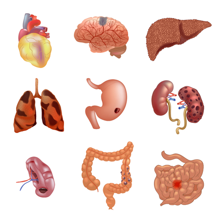 Realistic sick human organs set anatomyのイラスト素材