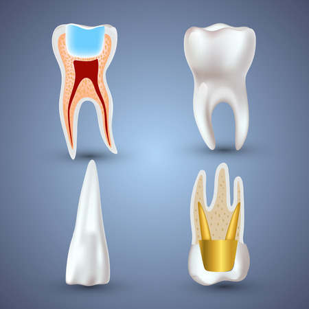 Vector set of 3d realistic clean and dirty tooth isolated on gray background. Dental health Concept. Oral Care, teeth restorationのイラスト素材