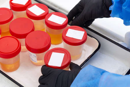Urine analysis in the laboratory. Medical urine test. Urine sample for laboratory analysis.