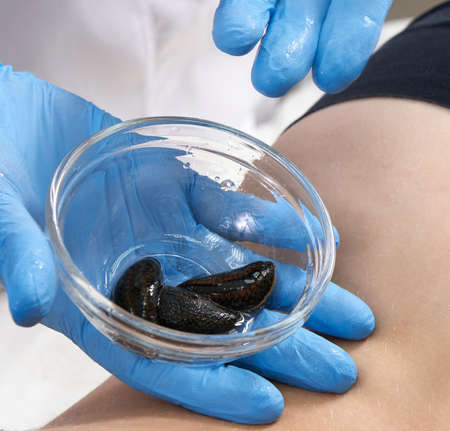Doctor holding medical leeches. Hirudotherapy. Alternative medicine, bloodletting and rejuvenation of the bodyの写真素材