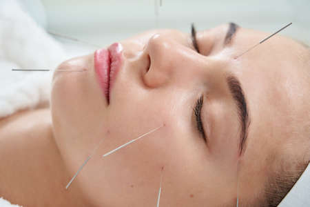 Young woman having an acupuncture treatment therapy on her face in spa salon. Alternative medicine and therapy conceptの写真素材