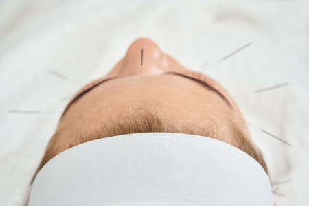 Young woman having an acupuncture treatment therapy on her face in spa salon. Alternative medicine...