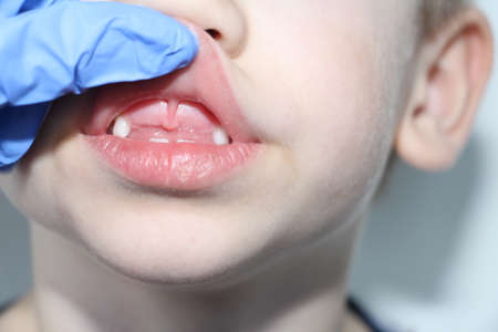 A dentist examines the baby teeth in the boy. The loss of milk teeth. The boy has no upper central...