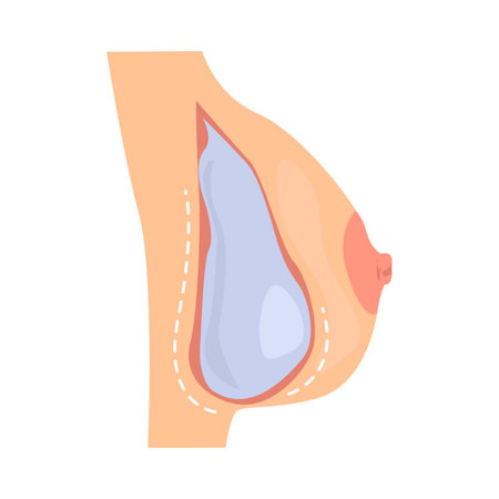 Breast augmentation illustration in color cartoon style. Editable vector graphic design.のイラスト素材