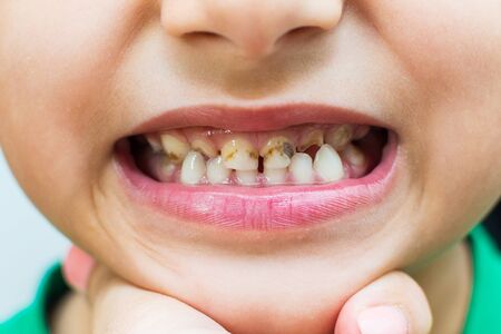 caries in the child. teeth with caries close-up. primary teeth.の写真素材