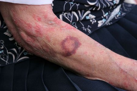 Bruise and sceriosis on the arm of an elderly female. The elderly have a tendency to bruise more...