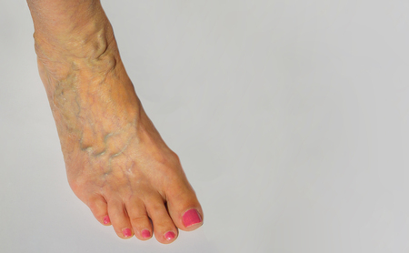 The varicose veins on a leg of old woman on grayの写真素材