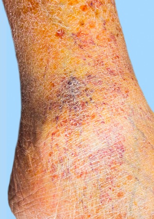 Close-up of skin with varicose veinsの写真素材